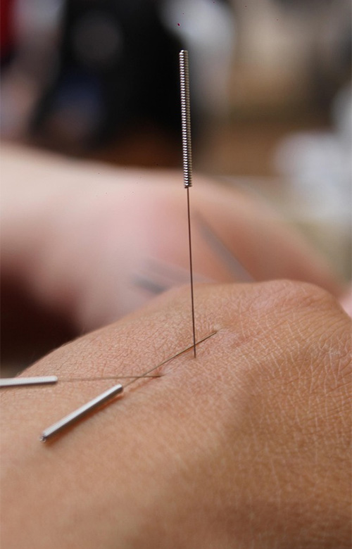 Acupuntura